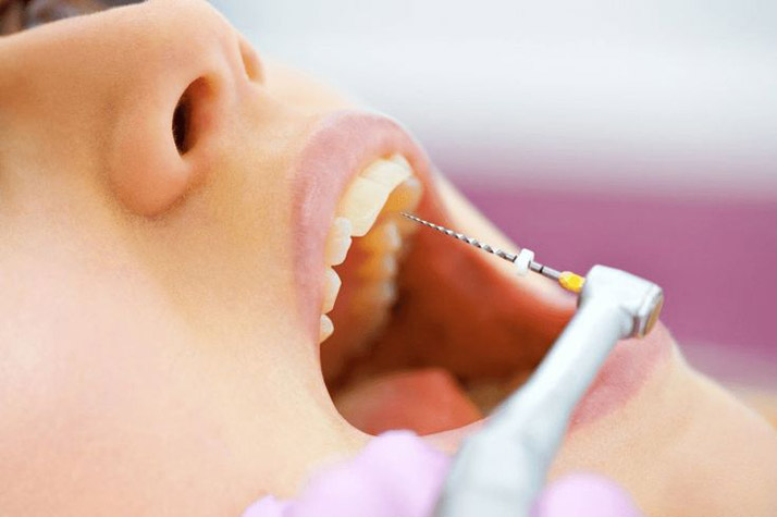 Every thing you should know about root canal treatment