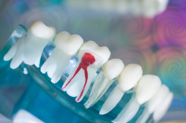 Why Do Doctors Recommend Microscopic Root Canal Treatment?
